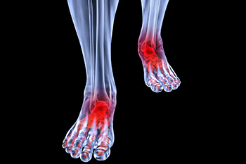 arthritic foot care in the Berks County, PA: Reading (Muhlenberg, Cumru, Wyomissing, Blandon, Shillington, Pennside, Birdsboro, West Reading, Sinking Spring, Laureldale, Reiffton, Fleetwood) and Philadelphia, PA areas