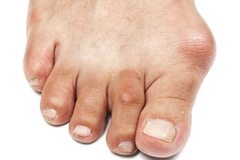 bunions treatment in the Berks County, PA: Reading (Muhlenberg, Cumru, Wyomissing, Blandon, Shillington, Pennside, Birdsboro, West Reading, Sinking Spring, Laureldale, Reiffton, Fleetwood) and Philadelphia, PA areas