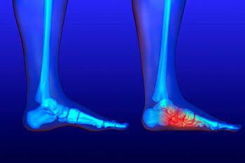 flat feet treatment in the Berks County, PA: Reading (Muhlenberg, Cumru, Wyomissing, Blandon, Shillington, Pennside, Birdsboro, West Reading, Sinking Spring, Laureldale, Reiffton, Fleetwood) and Philadelphia, PA areas