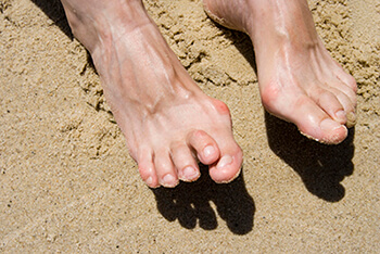 hammertoe and mallet toe treatment in the Berks County, PA: Reading (Muhlenberg, Cumru, Wyomissing, Blandon, Shillington, Pennside, Birdsboro, West Reading, Sinking Spring, Laureldale, Reiffton, Fleetwood) and Philadelphia, PA areas