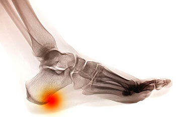 heel spur specialist in the Berks County, PA: Reading (Muhlenberg, Cumru, Wyomissing, Blandon, Shillington, Pennside, Birdsboro, West Reading, Sinking Spring, Laureldale, Reiffton, Fleetwood) and Philadelphia, PA areas