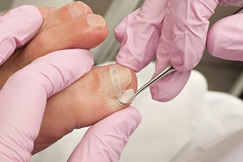 ingrown toenail treatment in the Berks County, PA: Reading (Muhlenberg, Cumru, Wyomissing, Blandon, Shillington, Pennside, Birdsboro, West Reading, Sinking Spring, Laureldale, Reiffton, Fleetwood) areas