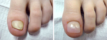 keryflex nail restoration in the Berks County, PA: Reading (Muhlenberg, Cumru, Wyomissing, Blandon, Shillington, Pennside, Birdsboro, West Reading, Sinking Spring, Laureldale, Reiffton, Fleetwood) and Philadelphia, PA areas