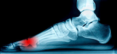 neuromas treatment in the Berks County, PA: Reading (Muhlenberg, Cumru, Wyomissing, Blandon, Shillington, Pennside, Birdsboro, West Reading, Sinking Spring, Laureldale, Reiffton, Fleetwood) and Philadelphia, PA areas