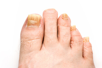 toenail fungus treatment in the Berks County, PA: Reading (Muhlenberg, Cumru, Wyomissing, Blandon, Shillington, Pennside, Birdsboro, West Reading, Sinking Spring, Laureldale, Reiffton, Fleetwood) and Philadelphia, PA areas