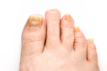 toenail fungus treatment in the Berks County, PA: Reading (Muhlenberg, Cumru, Wyomissing, Blandon, Shillington, Pennside, Birdsboro, West Reading, Sinking Spring, Laureldale, Reiffton, Fleetwood) areas