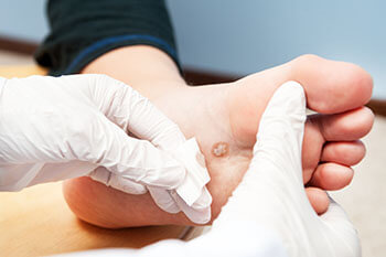 foot warts treatment in the Berks County, PA: Reading (Muhlenberg, Cumru, Wyomissing, Blandon, Shillington, Pennside, Birdsboro, West Reading, Sinking Spring, Laureldale, Reiffton, Fleetwood) and Philadelphia, PA areas