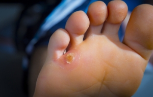 Safe Removal of Corns on the Feet