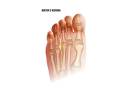 Understanding Morton's Neuroma