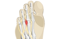 Morton’s Neuroma Explained